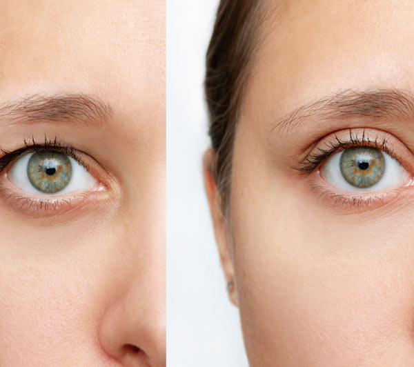 ניתוח הרמת עפעפיים