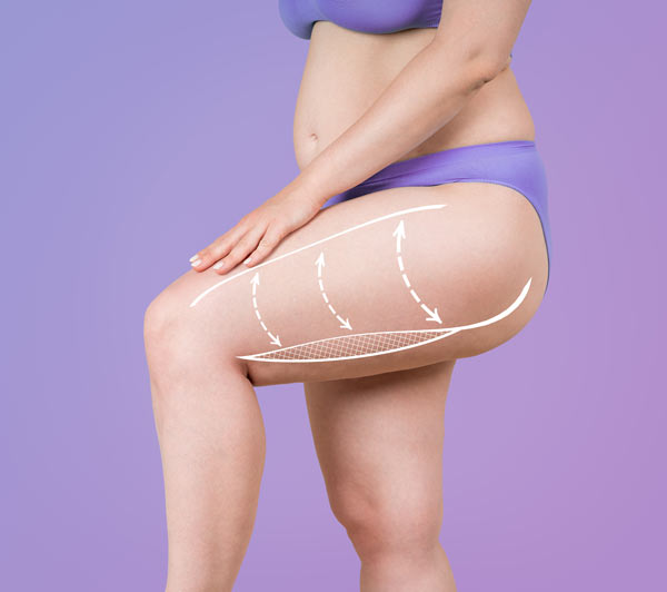 ניתוח מתיחת ירכיים