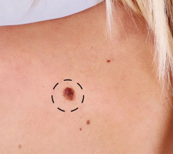 הסרת נגעי עור וסרחים