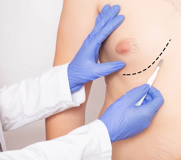 גניקומסטיה - הקטנת שדיים בגברים